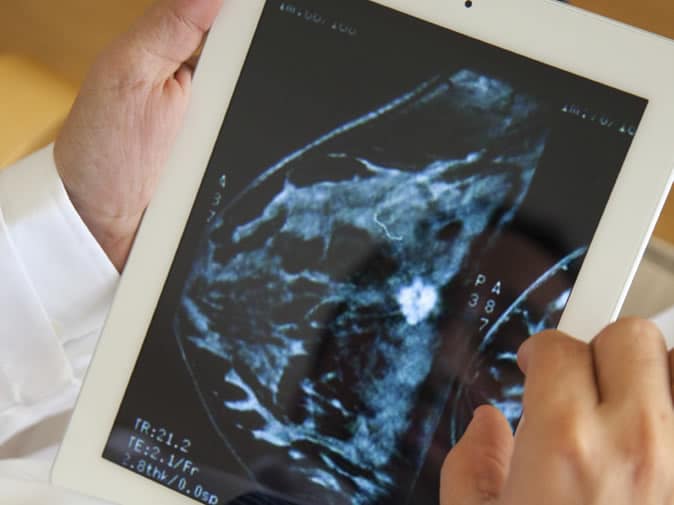 Digital Mammography