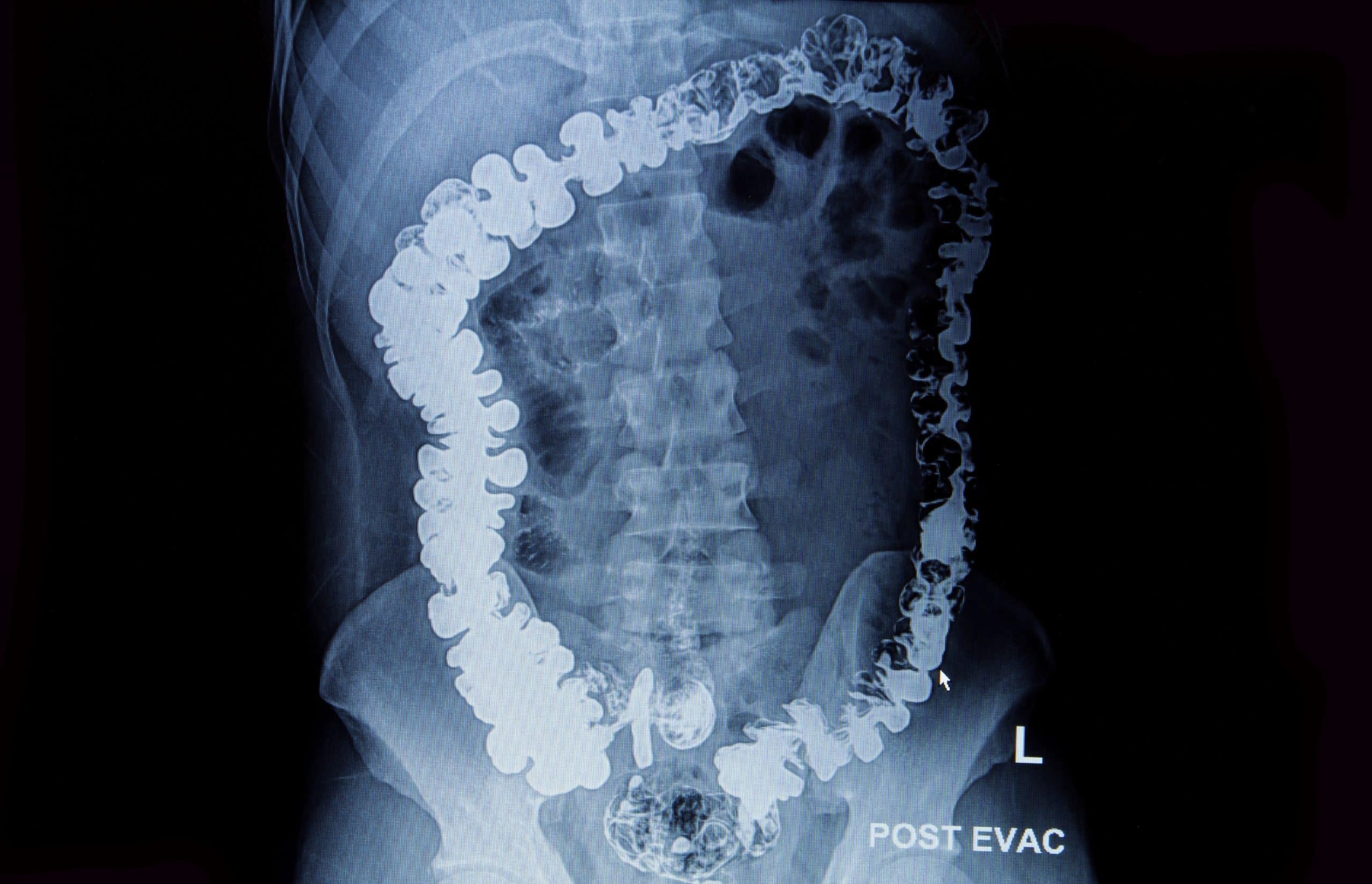 barium enema of a man demonstrated the normal rectum and cecum