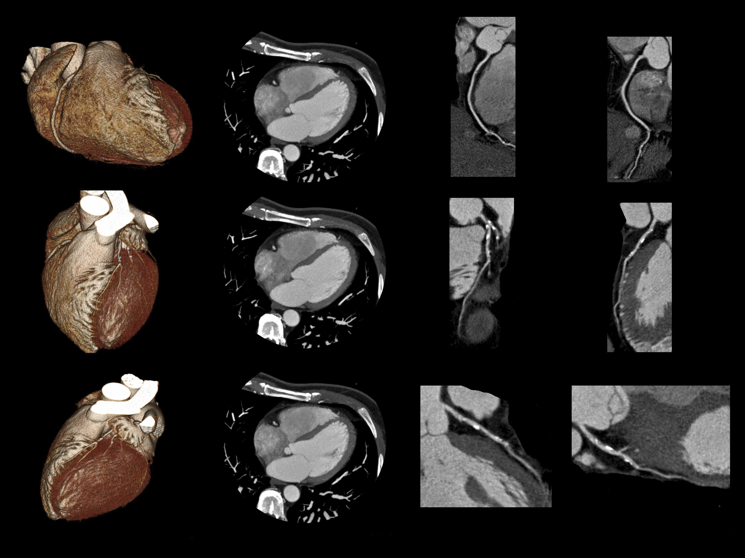 Heart-CT