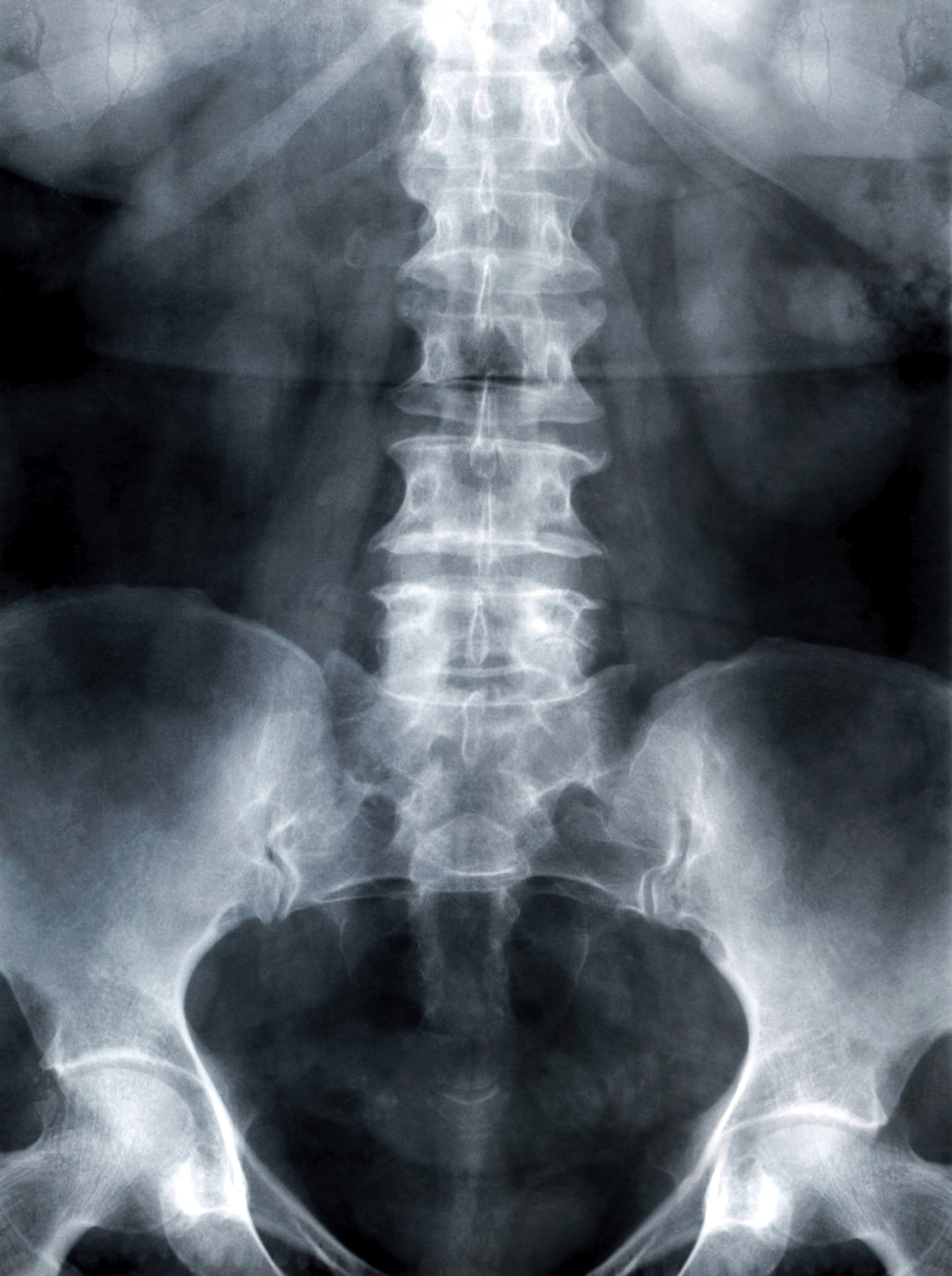 x-ray