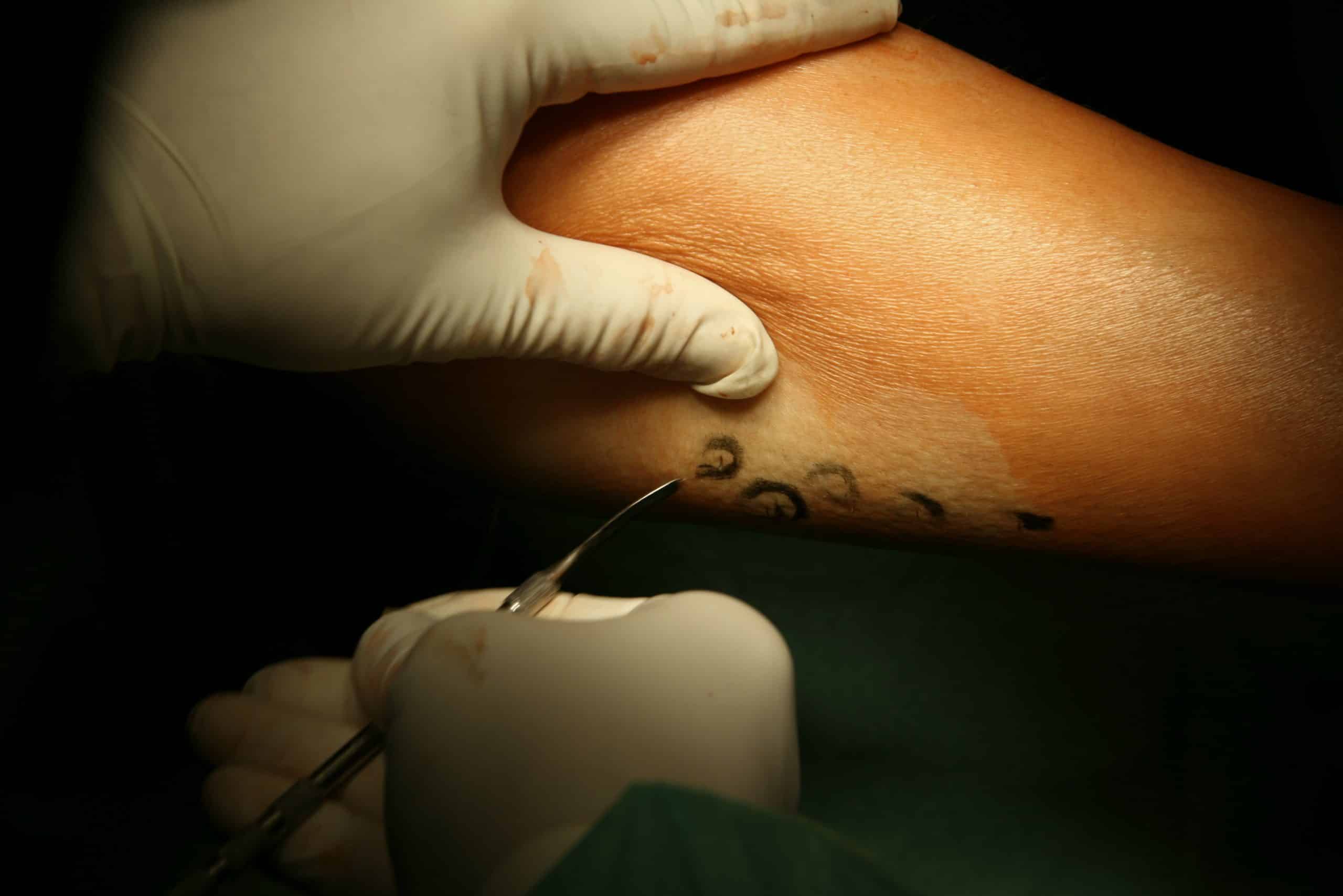ambulatory-phlebectomy