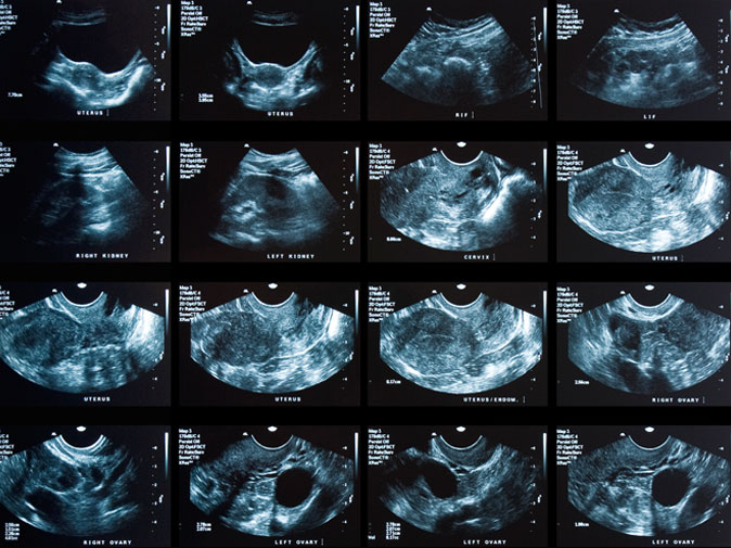 transvaginal-ultrasoun