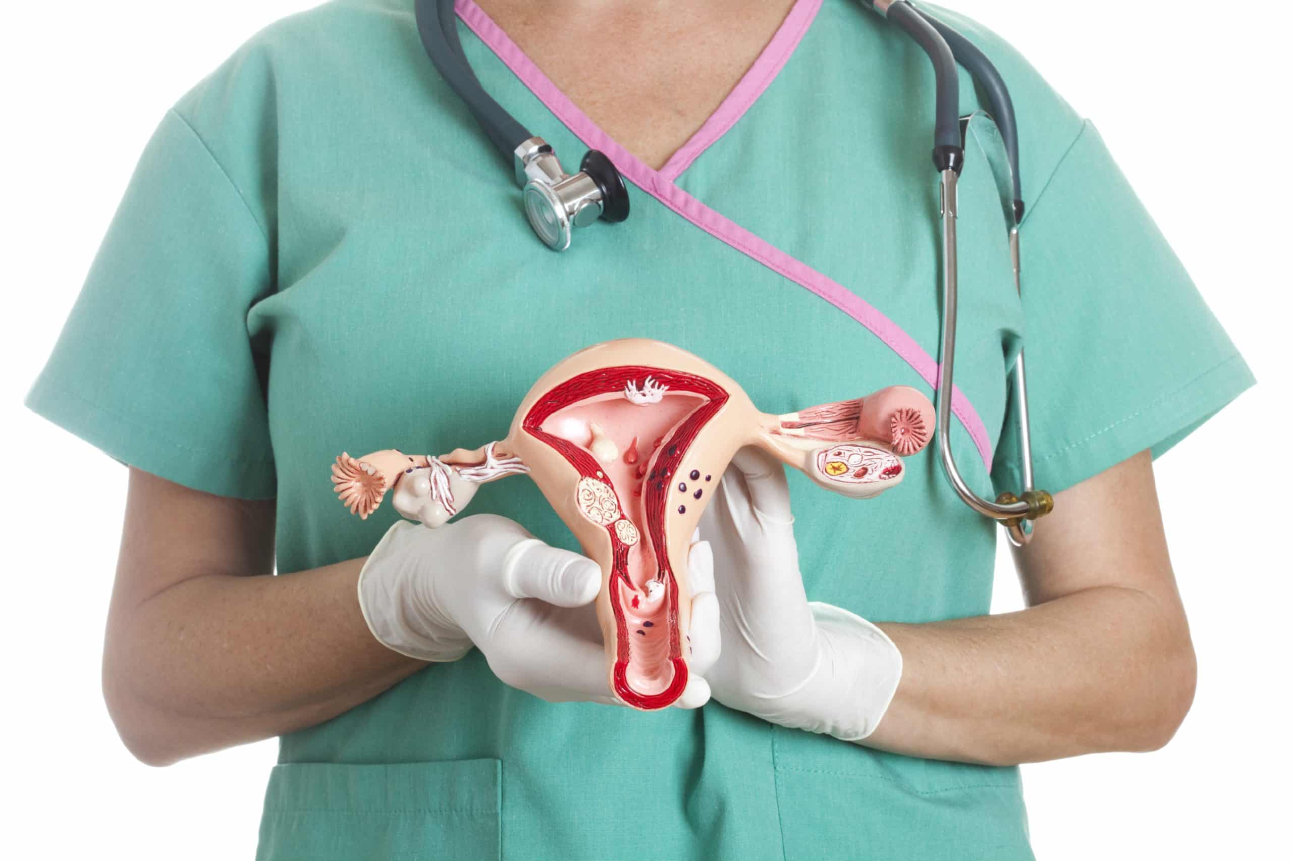 uterine-fibroid-embolization