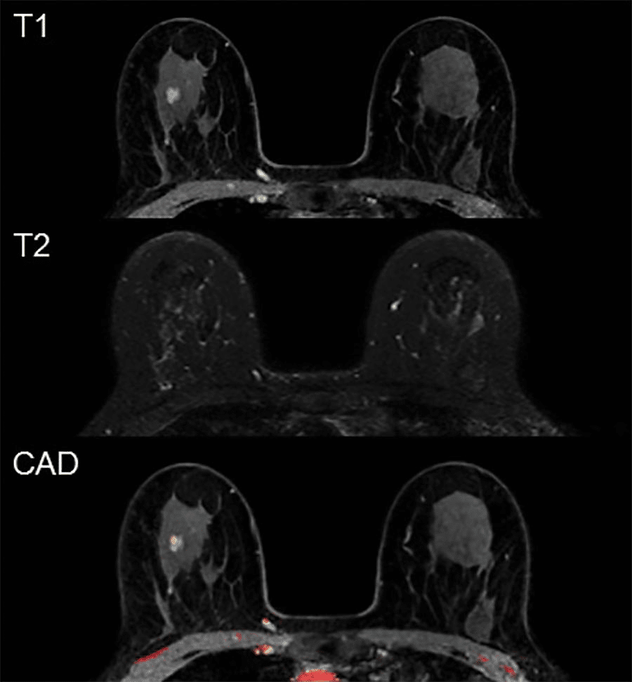 MRI Breast
